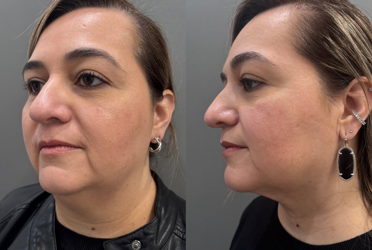 Neck Lift Before & After Gallery - Patient 262955 - Image 4