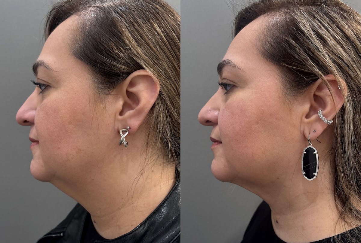 Neck Lift Before & After Gallery - Patient 262955 - Image 5