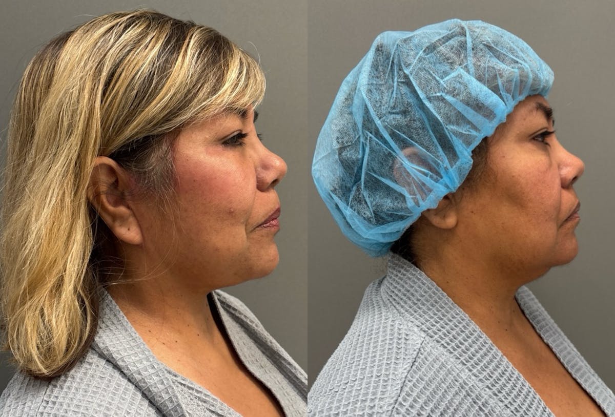 Facelift Before & After Gallery - Patient 126602 - Image 1