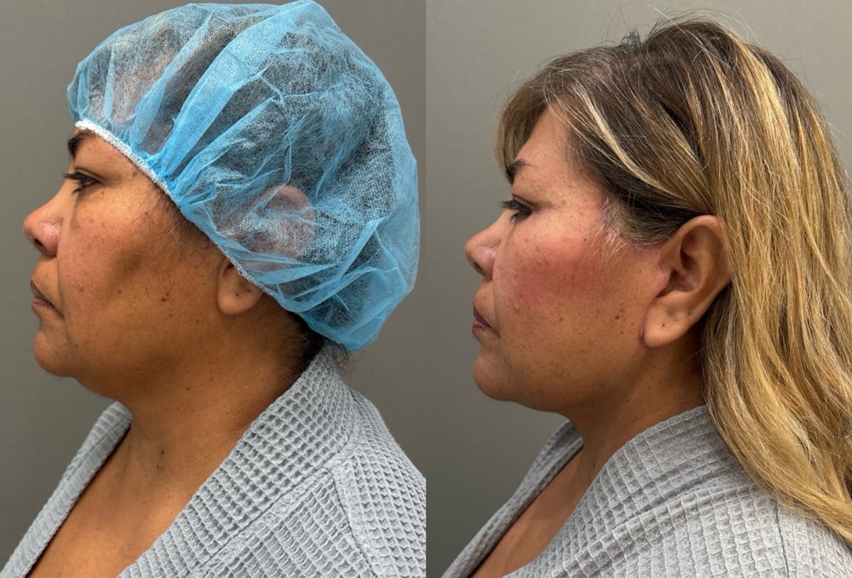 Facelift Before & After Gallery - Patient 126602 - Image 2
