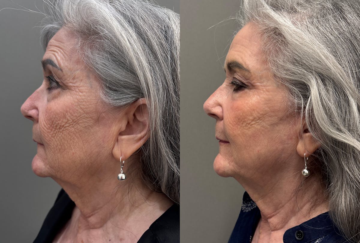 CO2 Laser Before & After Gallery - Patient 262759 - Image 5