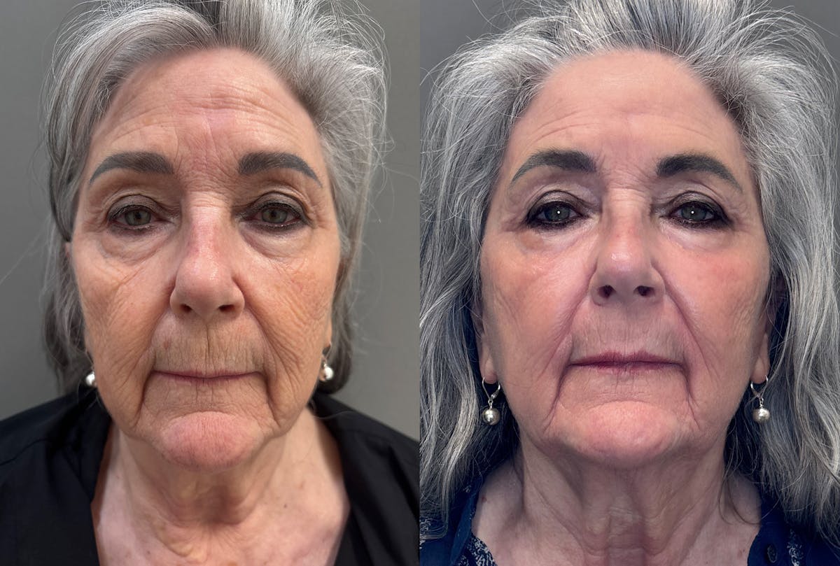 CO2 Laser Before & After Gallery - Patient 262759 - Image 1
