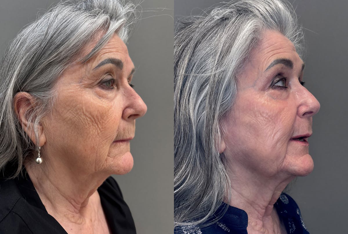 CO2 Laser Before & After Gallery - Patient 262759 - Image 2