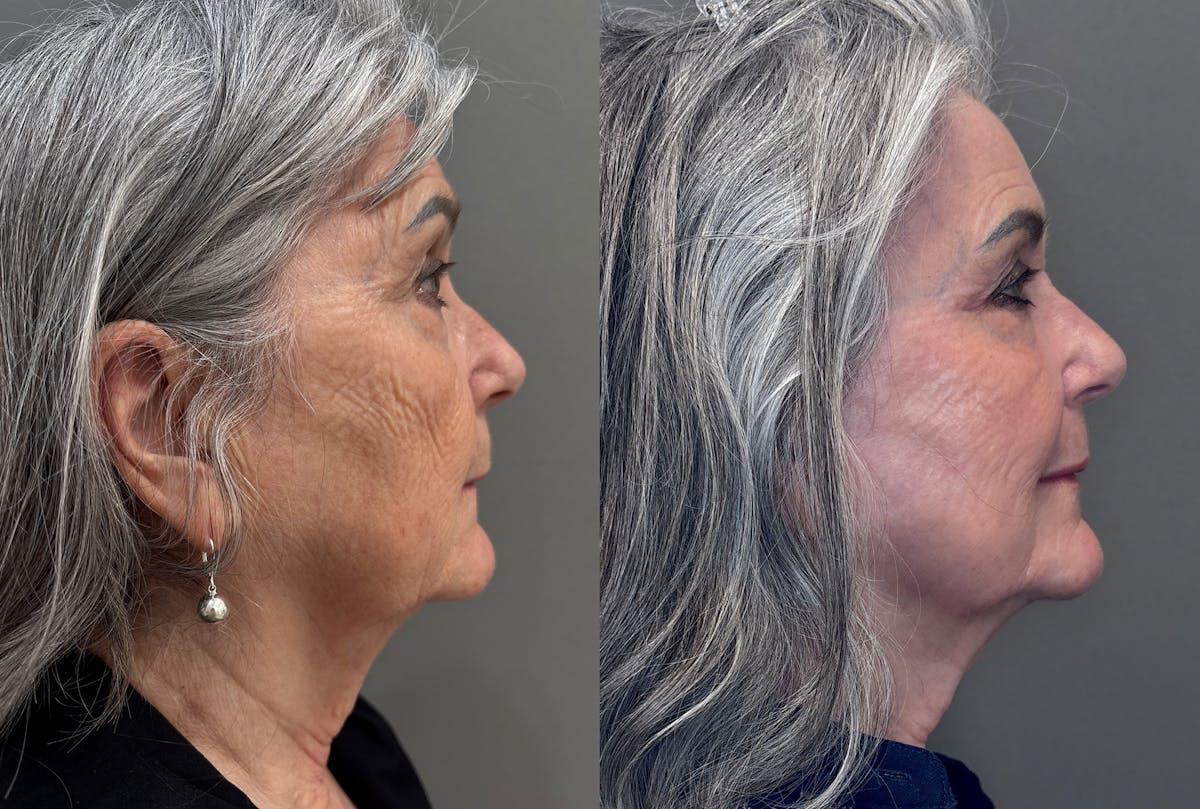 CO2 Laser Before & After Gallery - Patient 262759 - Image 3