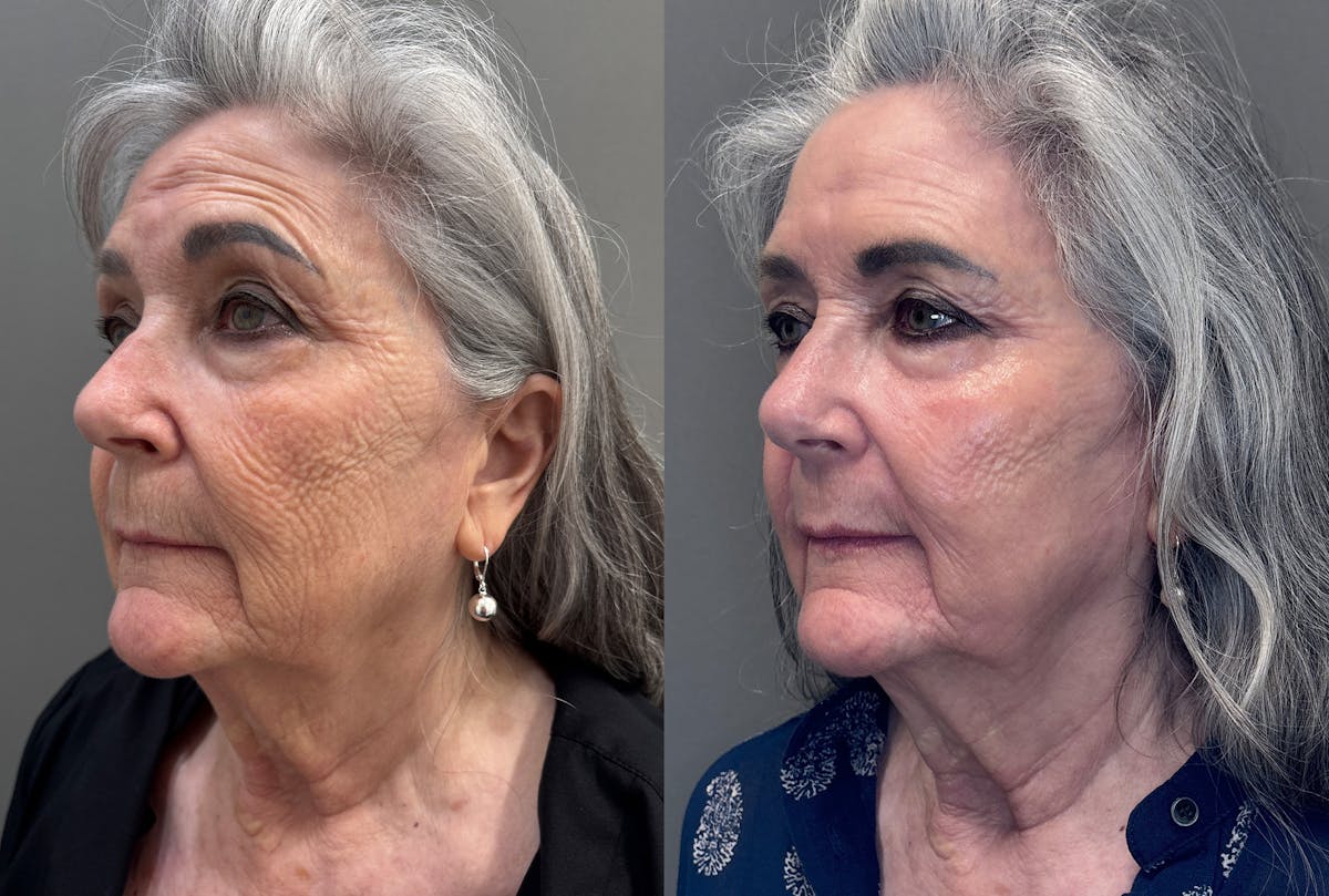 CO2 Laser Before & After Gallery - Patient 262759 - Image 4