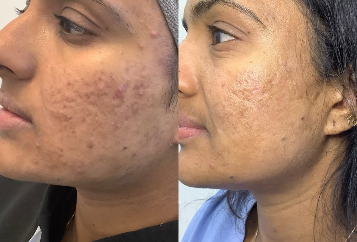 Morpheus8 Before & After Gallery - Patient 150380 - Image 2