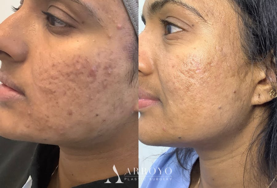 Morpheus8 Before & After Gallery - Patient 150380 - Image 2