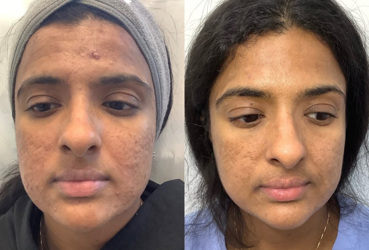 Morpheus8 Before & After Gallery - Patient 150380 - Image 1