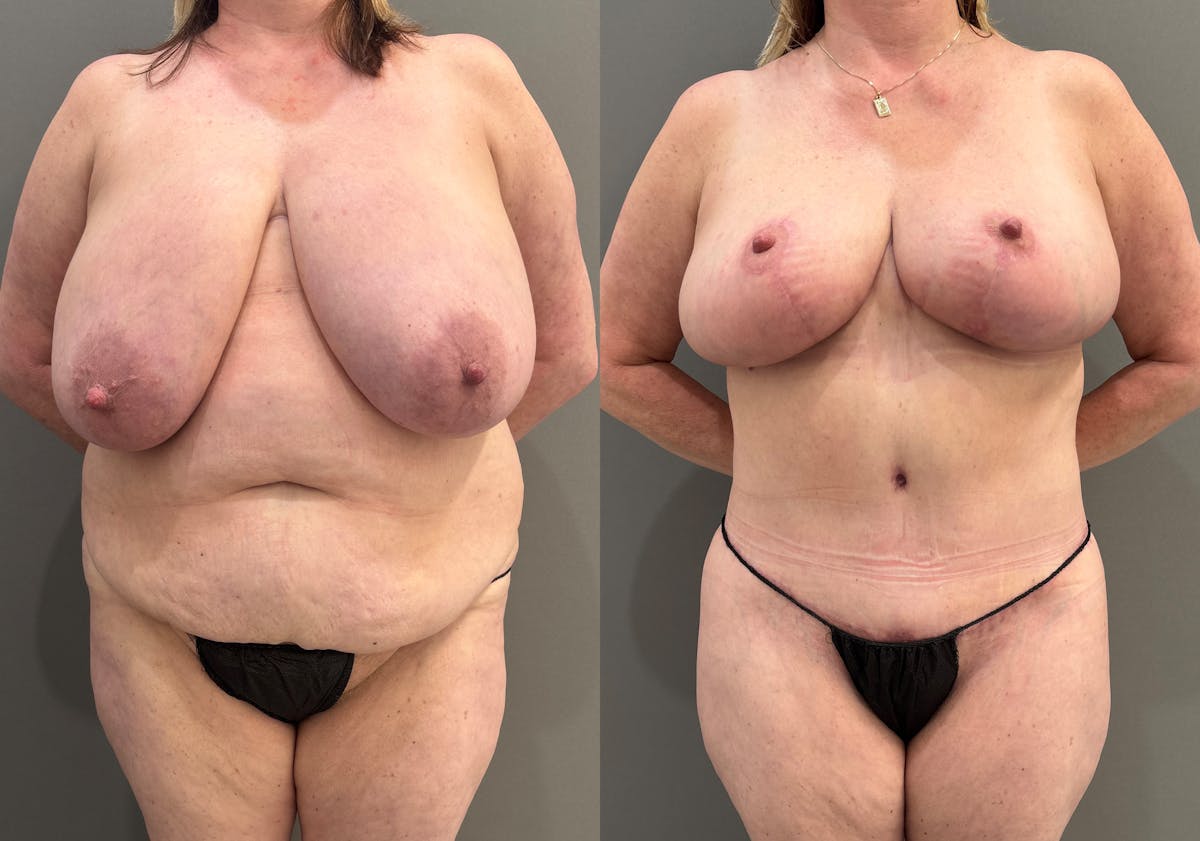 Tummy Tuck Before & After Gallery - Patient 385399 - Image 1