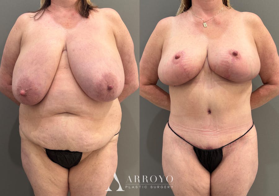 Breast Reduction Before & After Gallery - Patient 311168 - Image 1