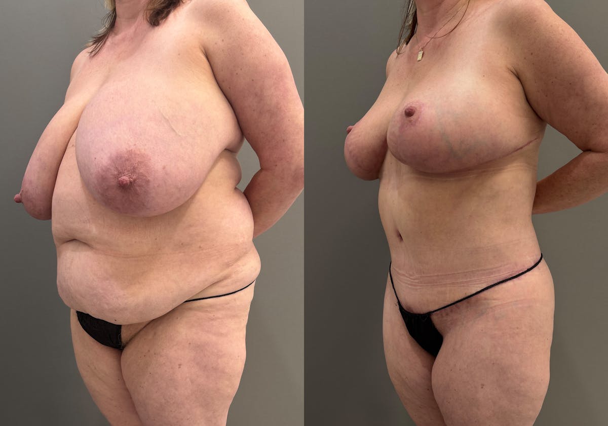 Tummy Tuck Before & After Gallery - Patient 385399 - Image 4