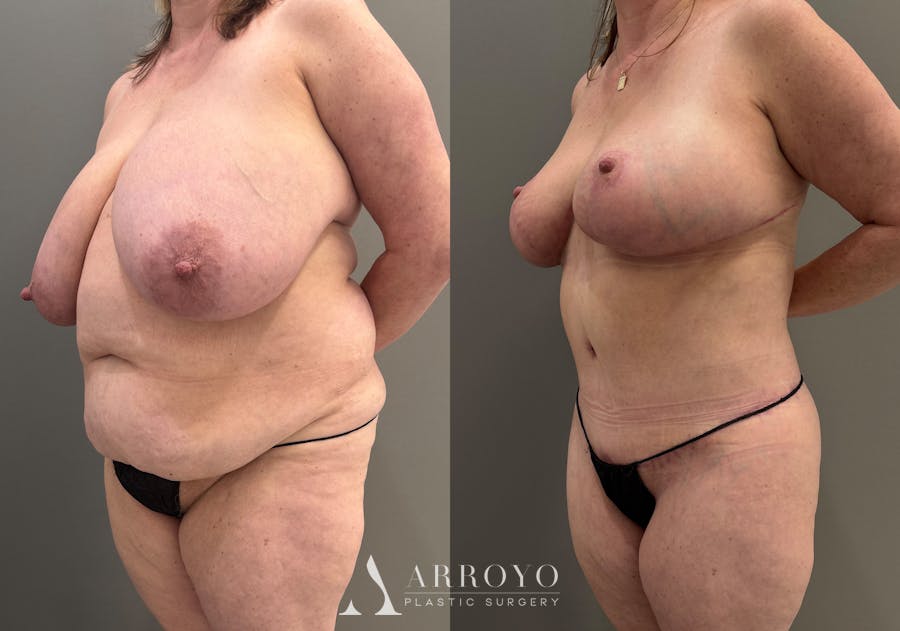 Breast Reduction Before & After Gallery - Patient 311168 - Image 4