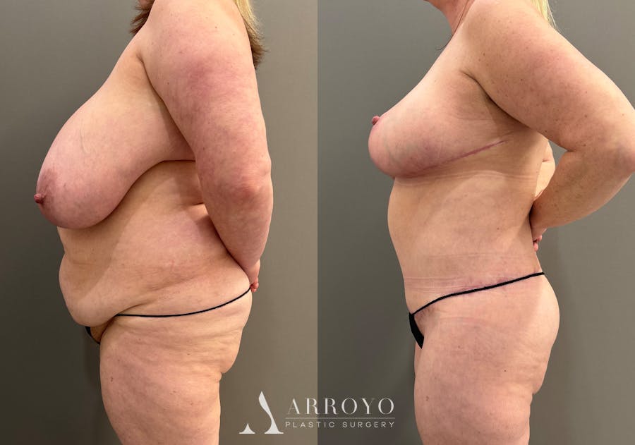 Breast Reduction Before & After Gallery - Patient 311168 - Image 5