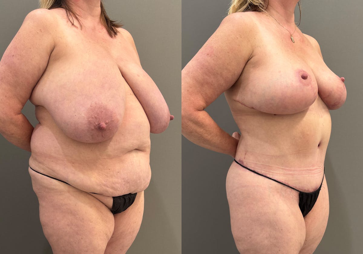 Tummy Tuck Before & After Gallery - Patient 385399 - Image 2