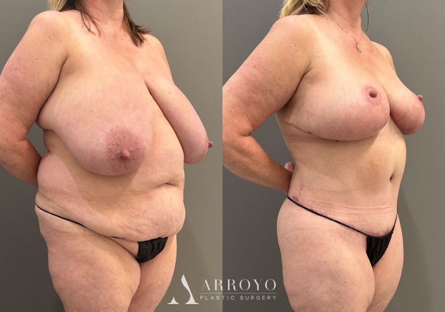 Breast Reduction Before & After Gallery - Patient 311168 - Image 2