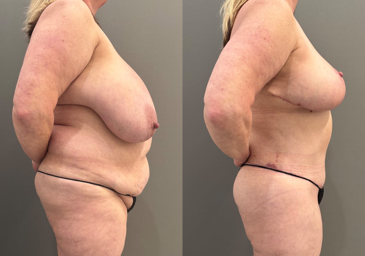 Tummy Tuck Before & After Gallery - Patient 385399 - Image 3