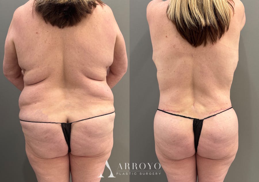 Breast Reduction Before & After Gallery - Patient 311168 - Image 6