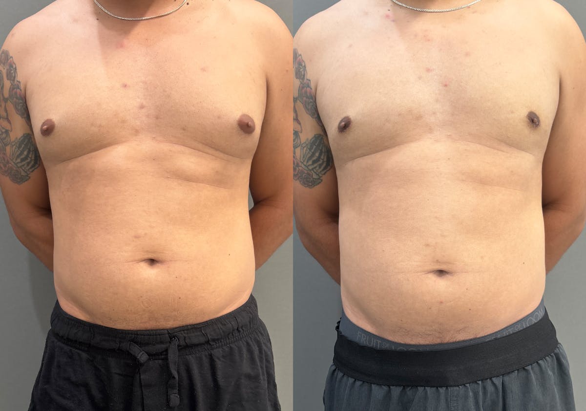 Gynecomastia Before & After Gallery - Patient 161165 - Image 1