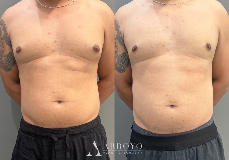 Gynecomastia Before & After Gallery - Patient 161165 - Image 1