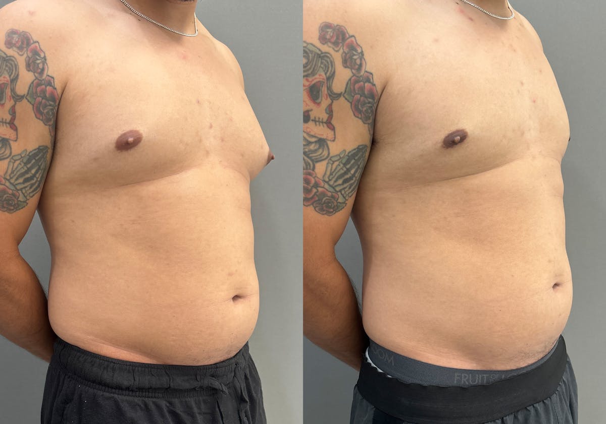 Gynecomastia Before & After Gallery - Patient 161165 - Image 2