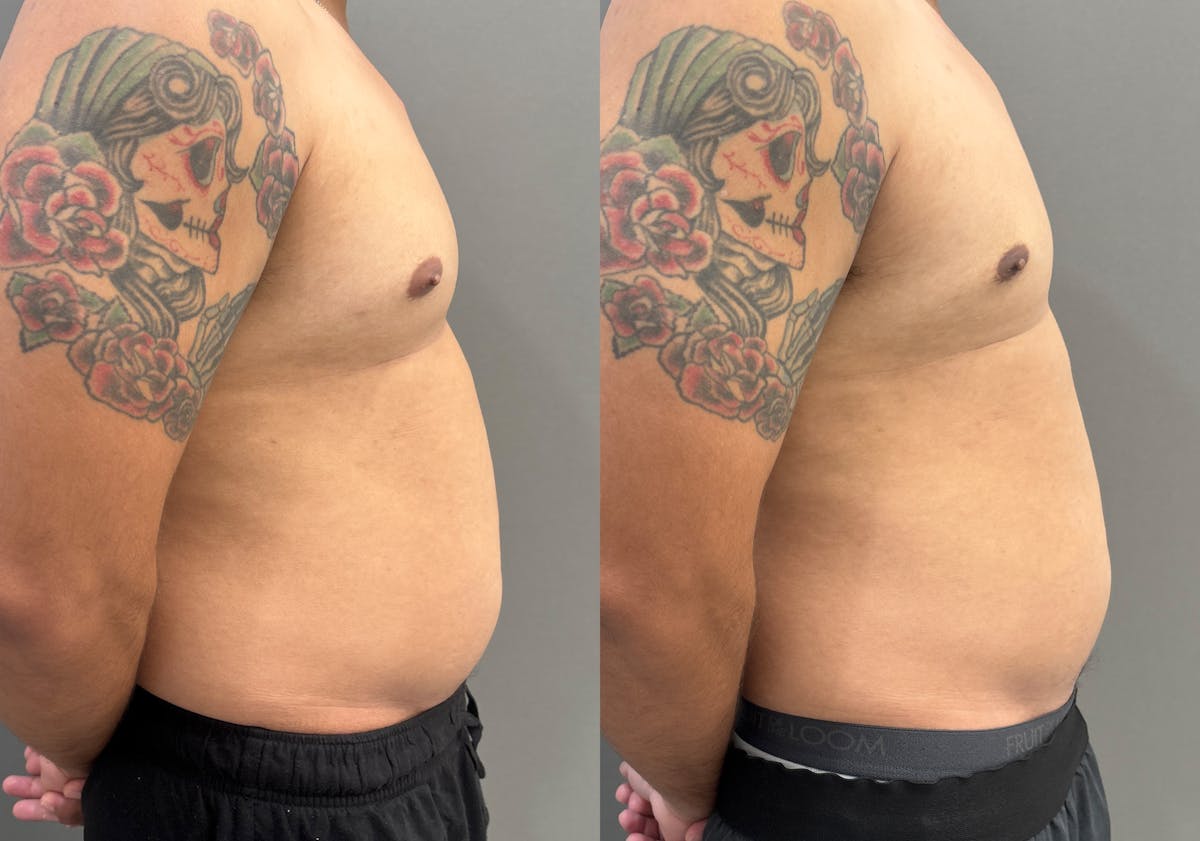 Gynecomastia Before & After Gallery - Patient 161165 - Image 3