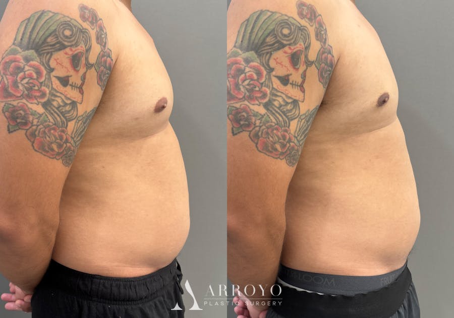 Gynecomastia Before & After Gallery - Patient 161165 - Image 3