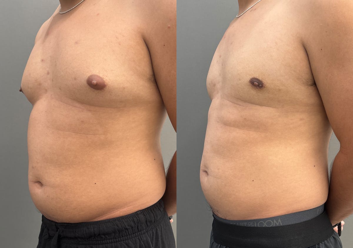 Gynecomastia Before & After Gallery - Patient 161165 - Image 4