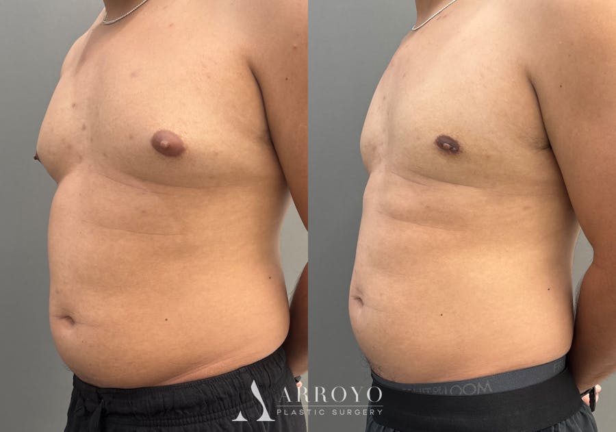 Gynecomastia Before & After Gallery - Patient 161165 - Image 4