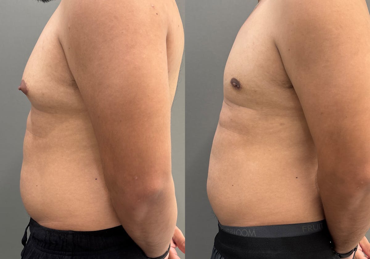 Gynecomastia Before & After Gallery - Patient 161165 - Image 5