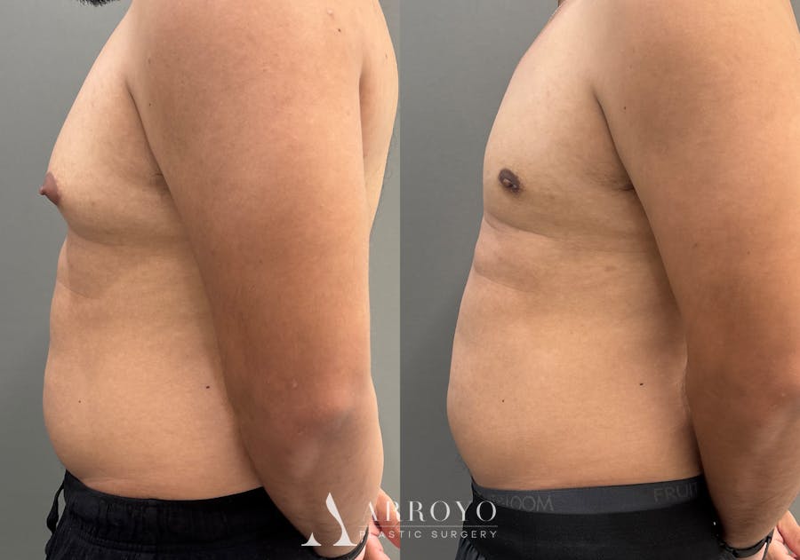 Gynecomastia Before & After Gallery - Patient 161165 - Image 5