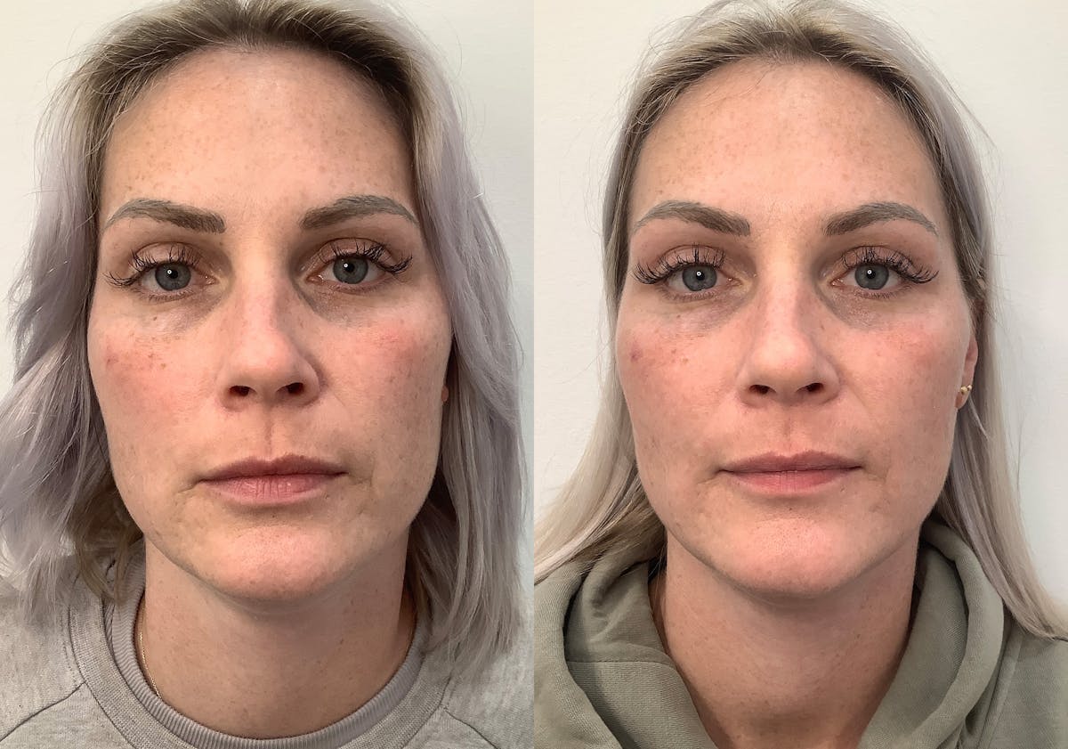 Morpheus8 Before & After Gallery - Patient 266132 - Image 1