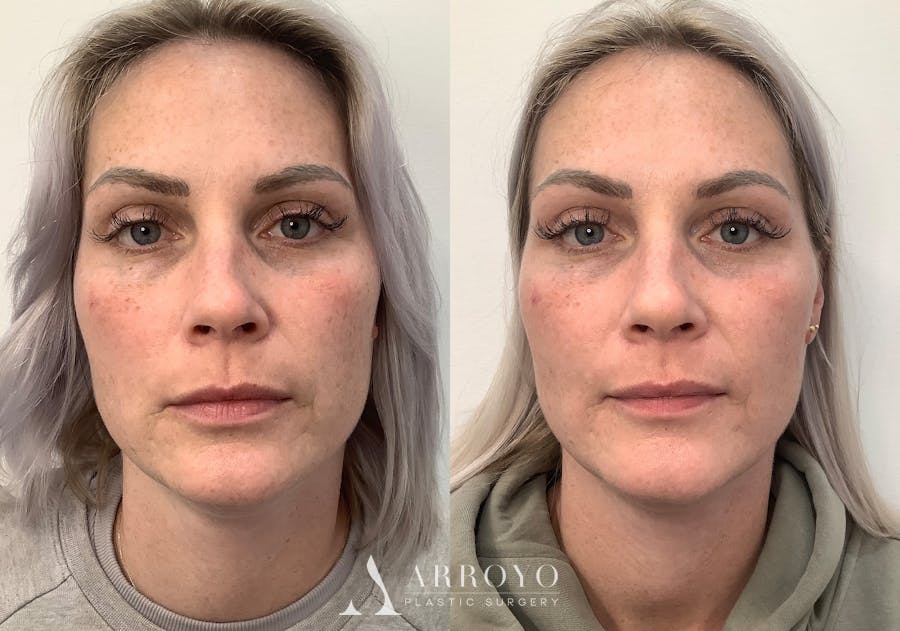 Morpheus8 Before & After Gallery - Patient 266132 - Image 1