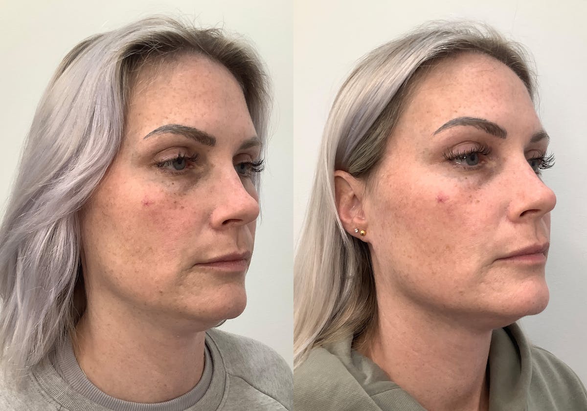 Morpheus8 Before & After Gallery - Patient 266132 - Image 2