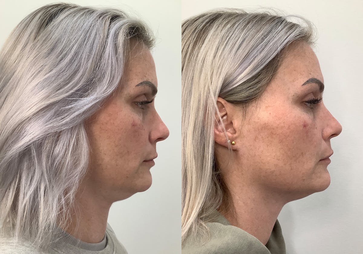 Morpheus8 Before & After Gallery - Patient 266132 - Image 3