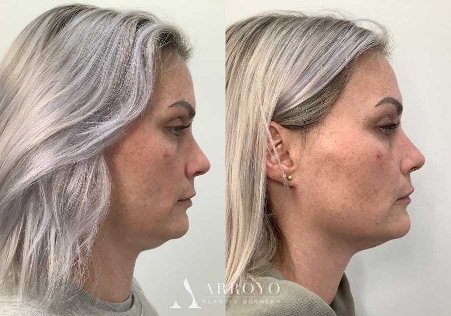 Morpheus8 Before & After Gallery - Patient 266132 - Image 3