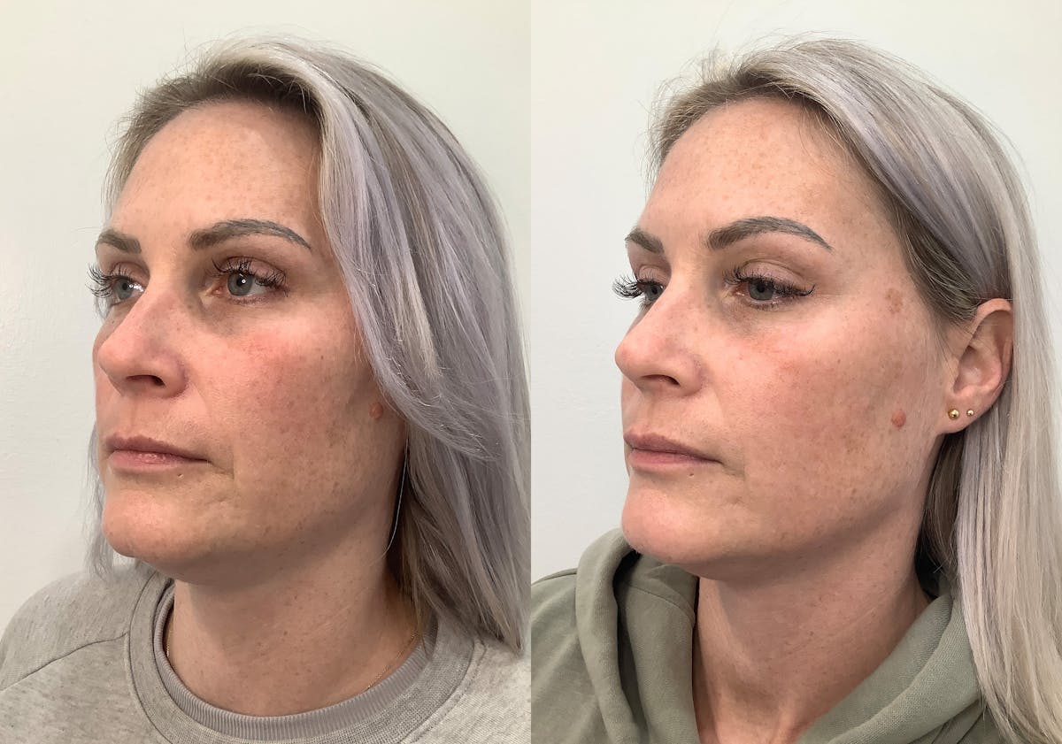 Morpheus8 Before & After Gallery - Patient 266132 - Image 4