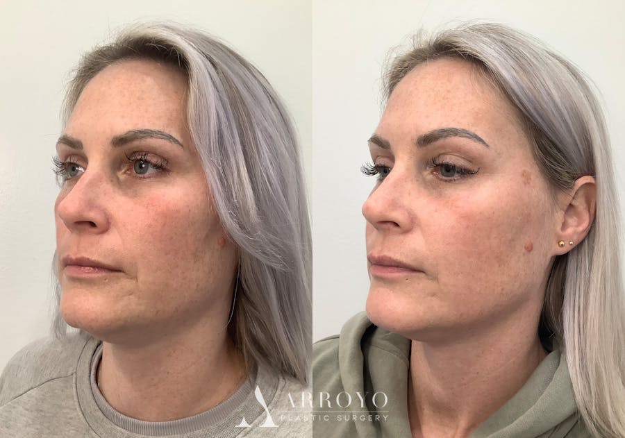 Morpheus8 Before & After Gallery - Patient 266132 - Image 4