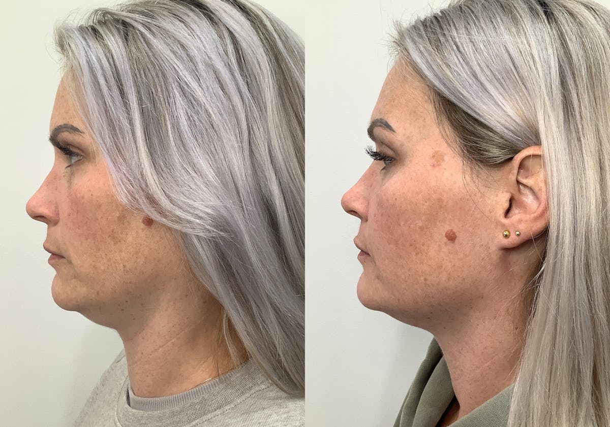 Morpheus8 Before & After Gallery - Patient 266132 - Image 5