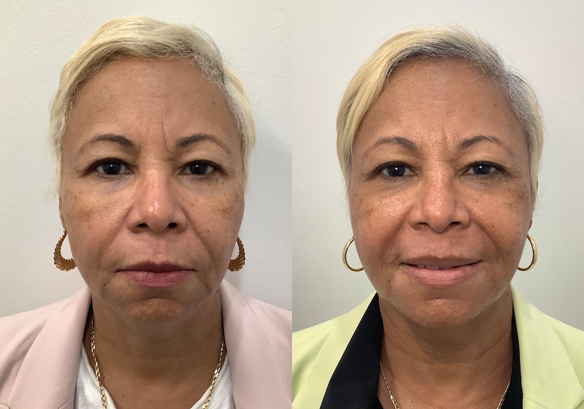 Morpheus8 Before & After Gallery - Patient 194233 - Image 1