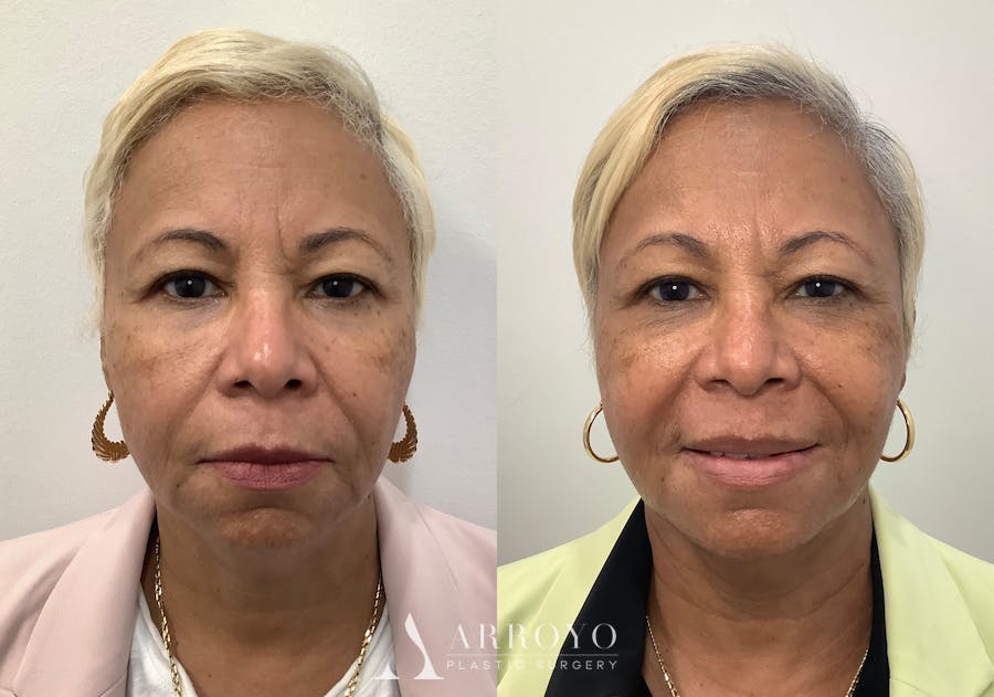 Morpheus8 Before & After Gallery - Patient 194233 - Image 1