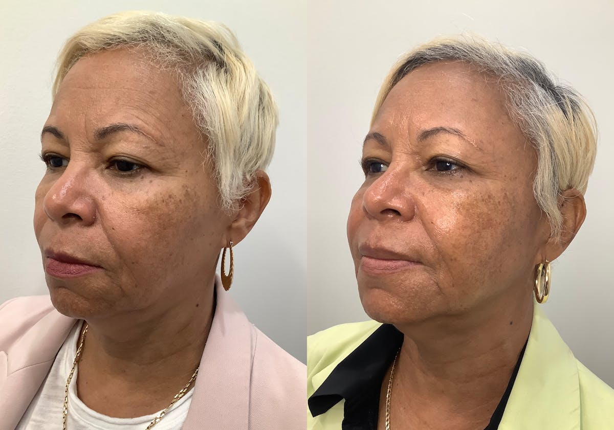 Morpheus8 Before & After Gallery - Patient 194233 - Image 4