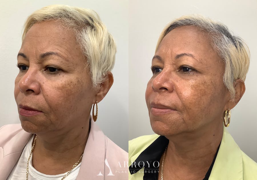 Morpheus8 Before & After Gallery - Patient 194233 - Image 4