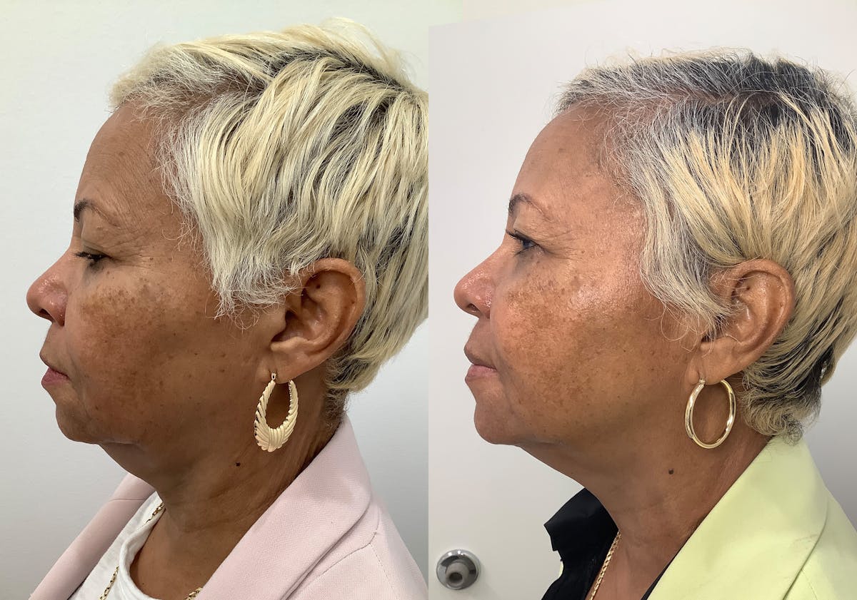 Morpheus8 Before & After Gallery - Patient 194233 - Image 5