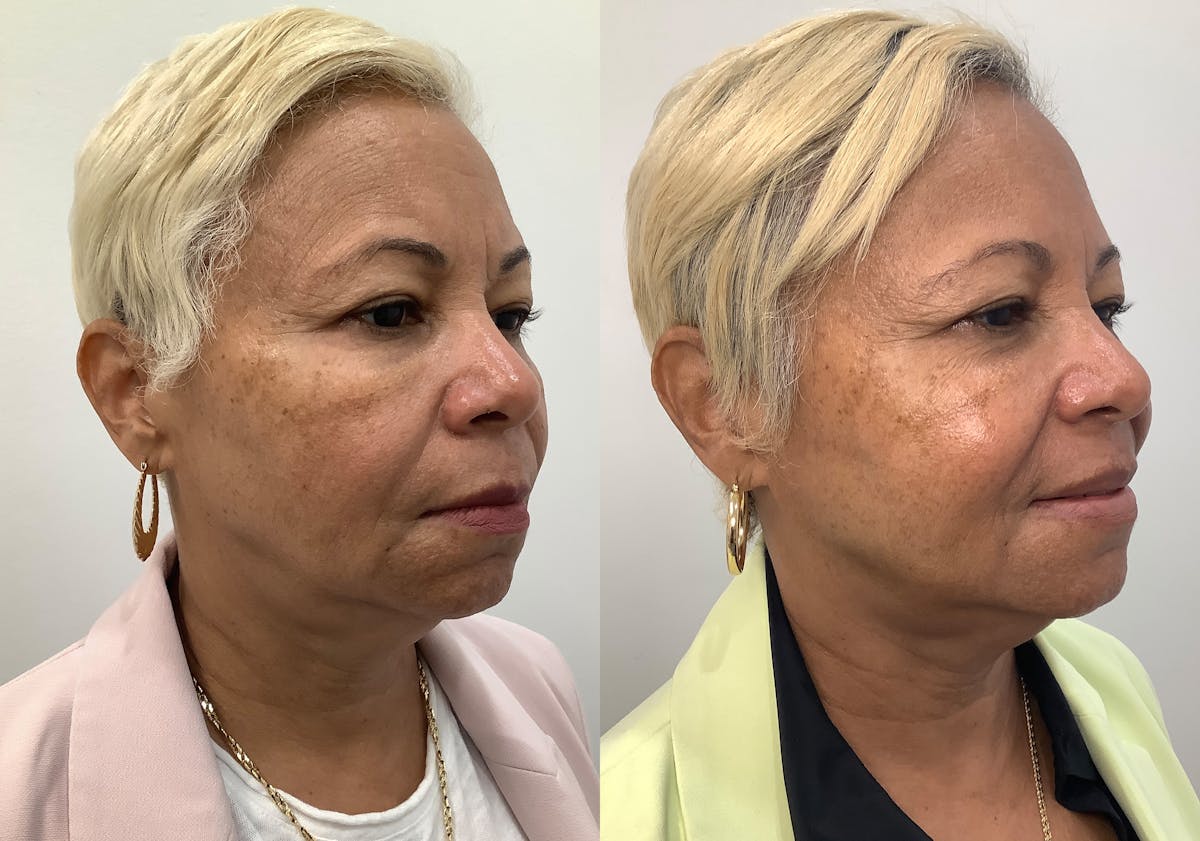 Morpheus8 Before & After Gallery - Patient 194233 - Image 2