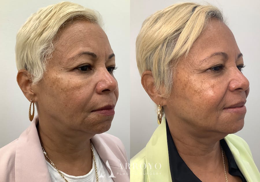 Morpheus8 Before & After Gallery - Patient 194233 - Image 2