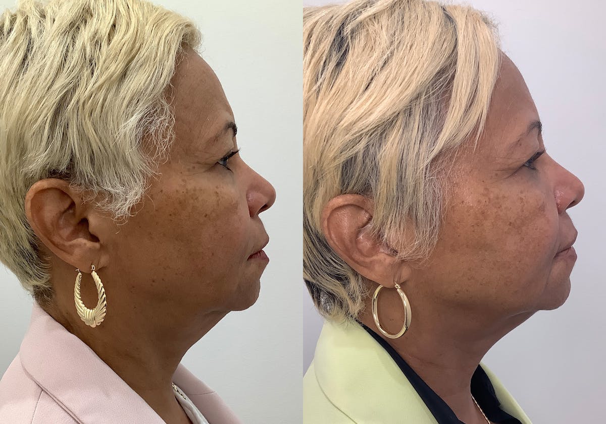 Morpheus8 Before & After Gallery - Patient 194233 - Image 3