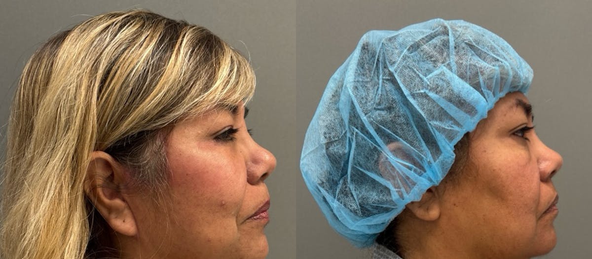 Blepharoplasty Before & After Gallery - Patient 283869 - Image 1