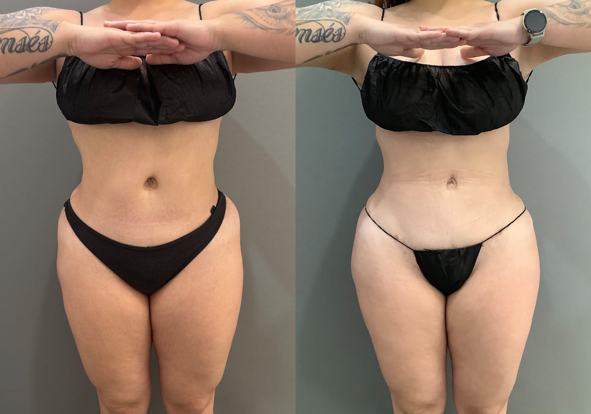 Liposuction Before & After Gallery - Patient 705659 - Image 1