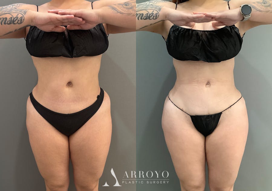 Liposuction Before & After Gallery - Patient 705659 - Image 1