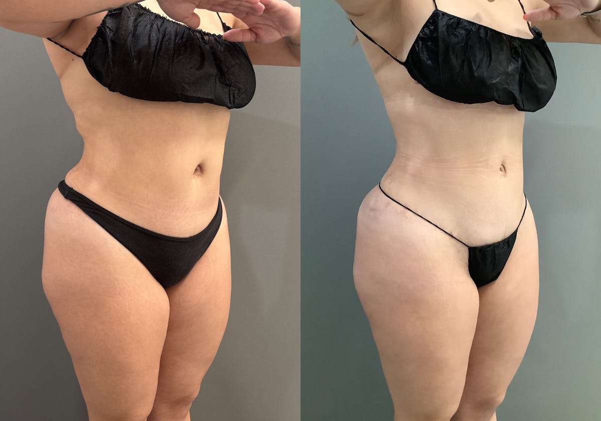 Liposuction Before & After Gallery - Patient 705659 - Image 2